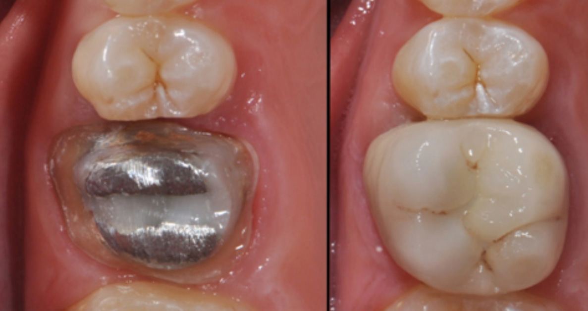 All-ceramic dental crowns with natural translucent shade
