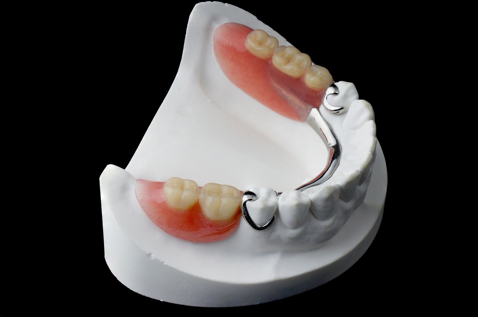 Cast partial denture with metal framework and acrylic teeth