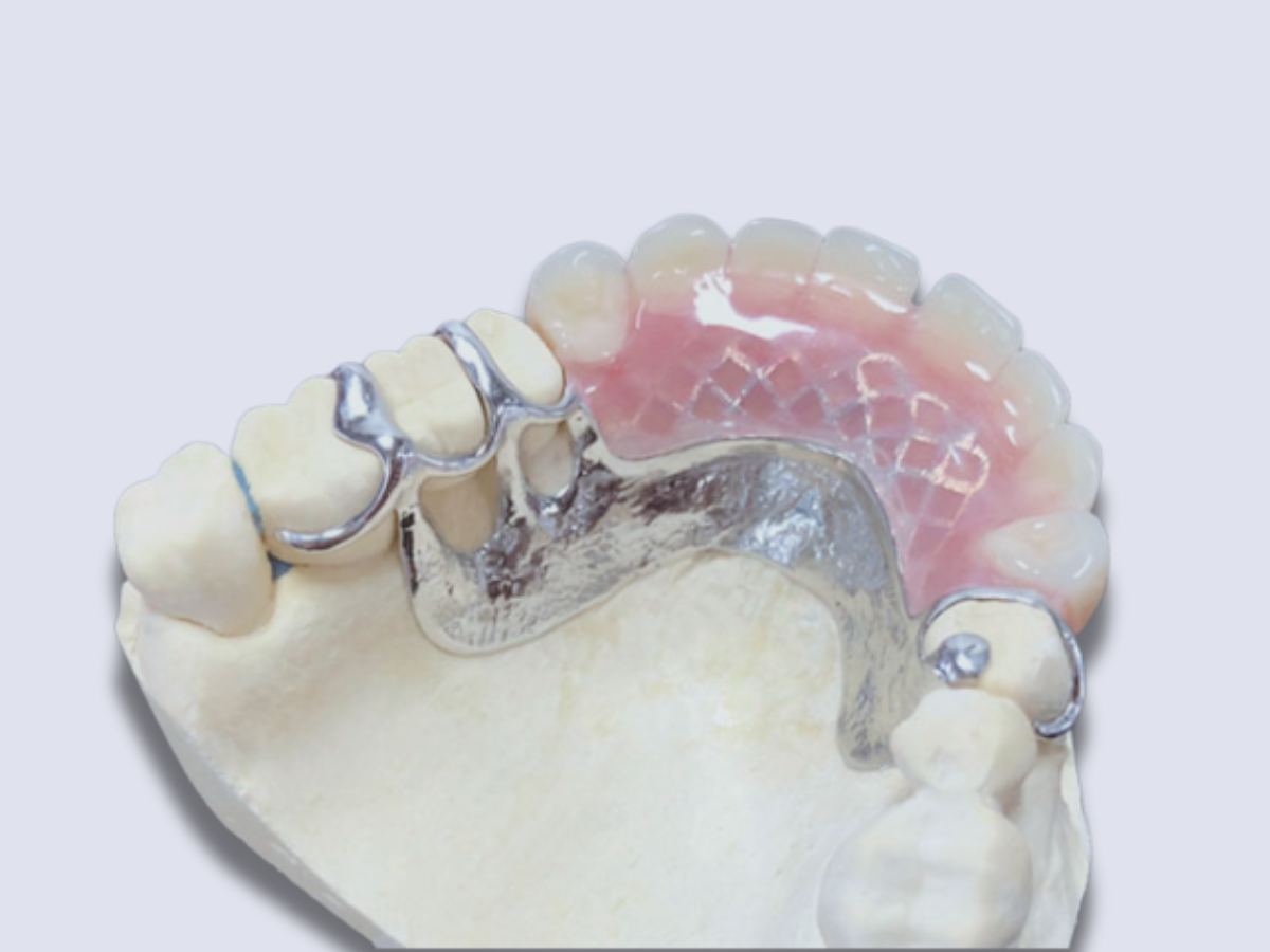 Vitallium cast partial framework detail