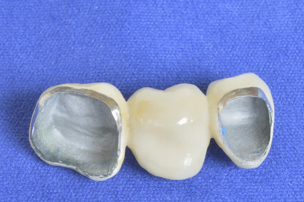 PFM crowns with porcelain shade and metal-supported strength