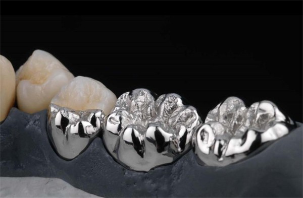 Porcelain fused to metal bridge crown restoration