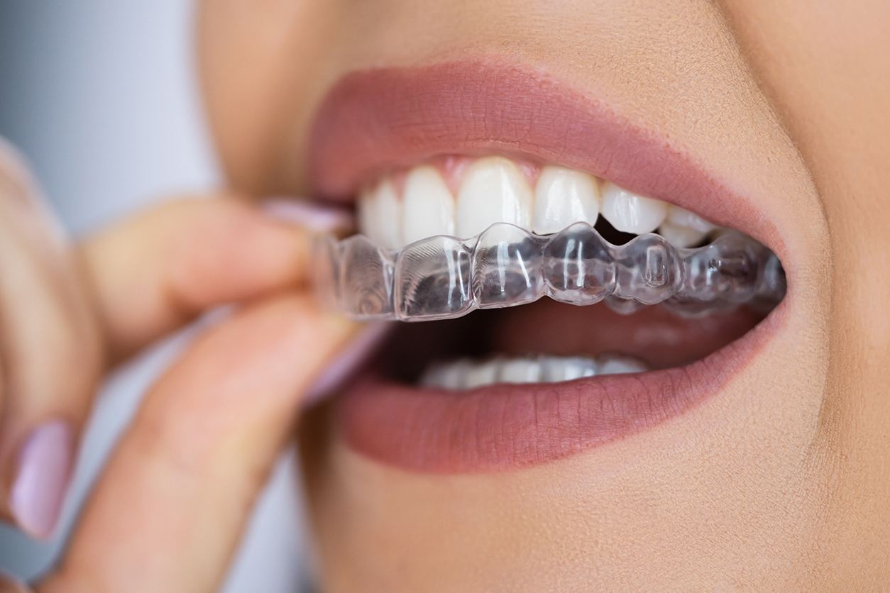 Clear orthodontic retainer on dental model